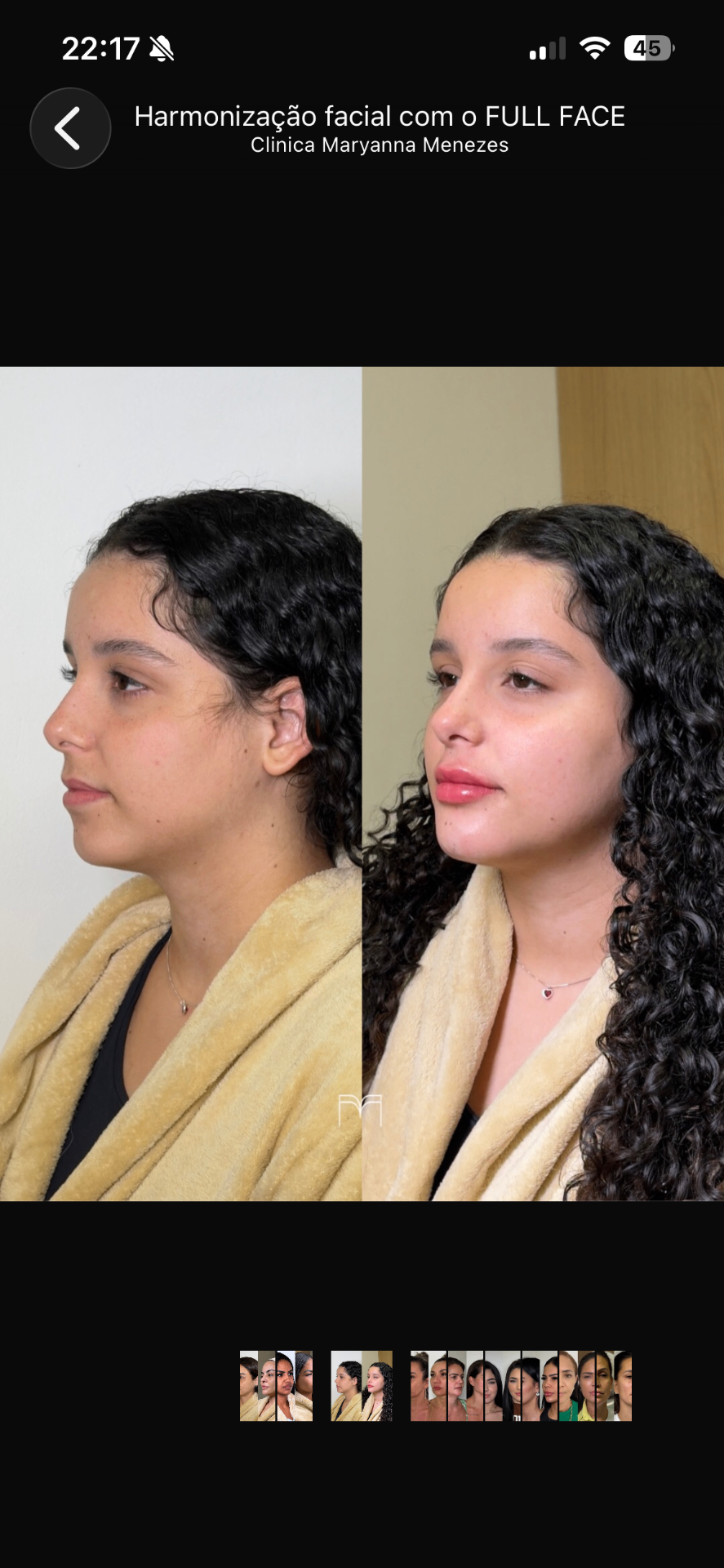 Full Face — caso 1