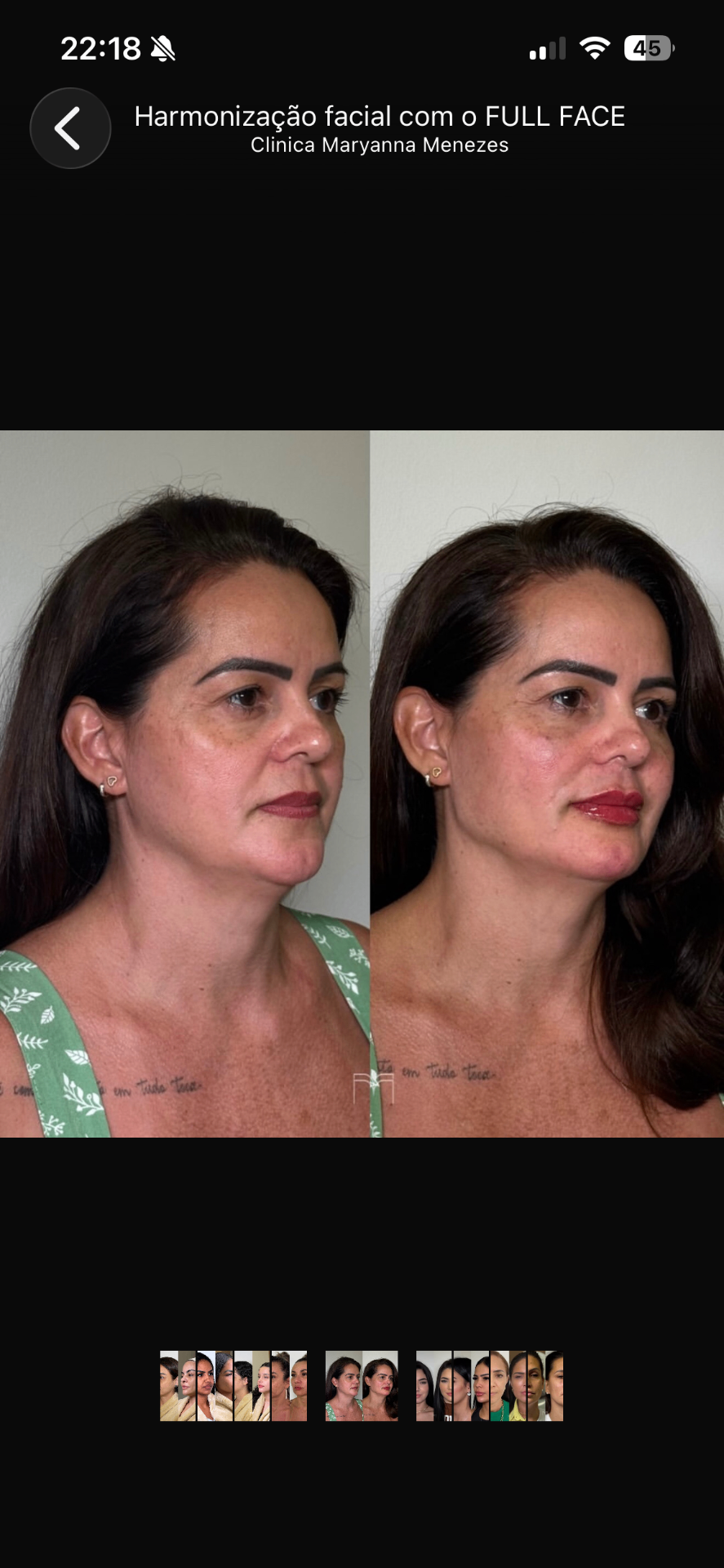 Full Face — caso 5