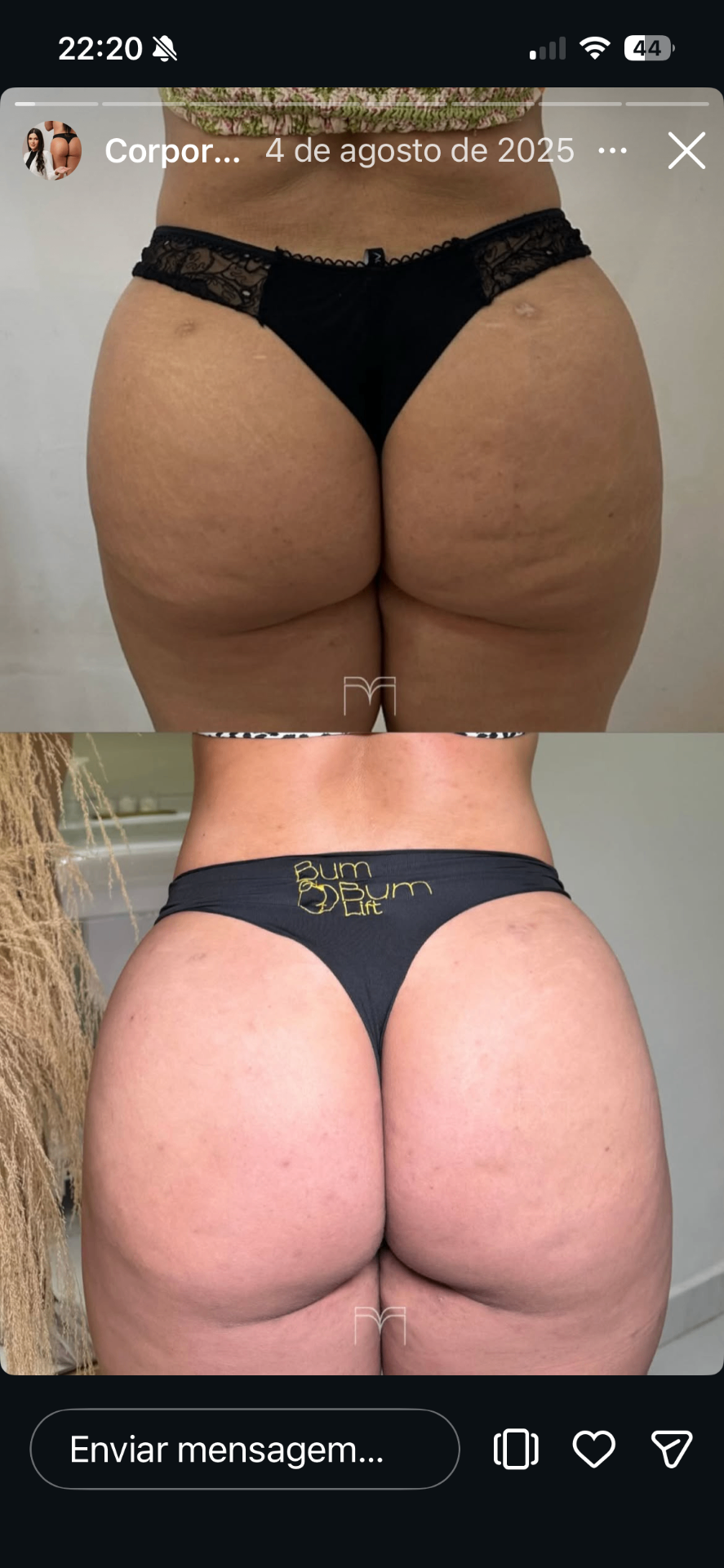 Bumbum Lift — caso 9