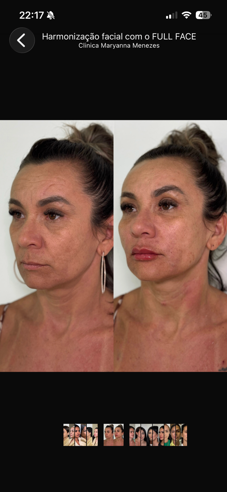 Full Face — caso 4