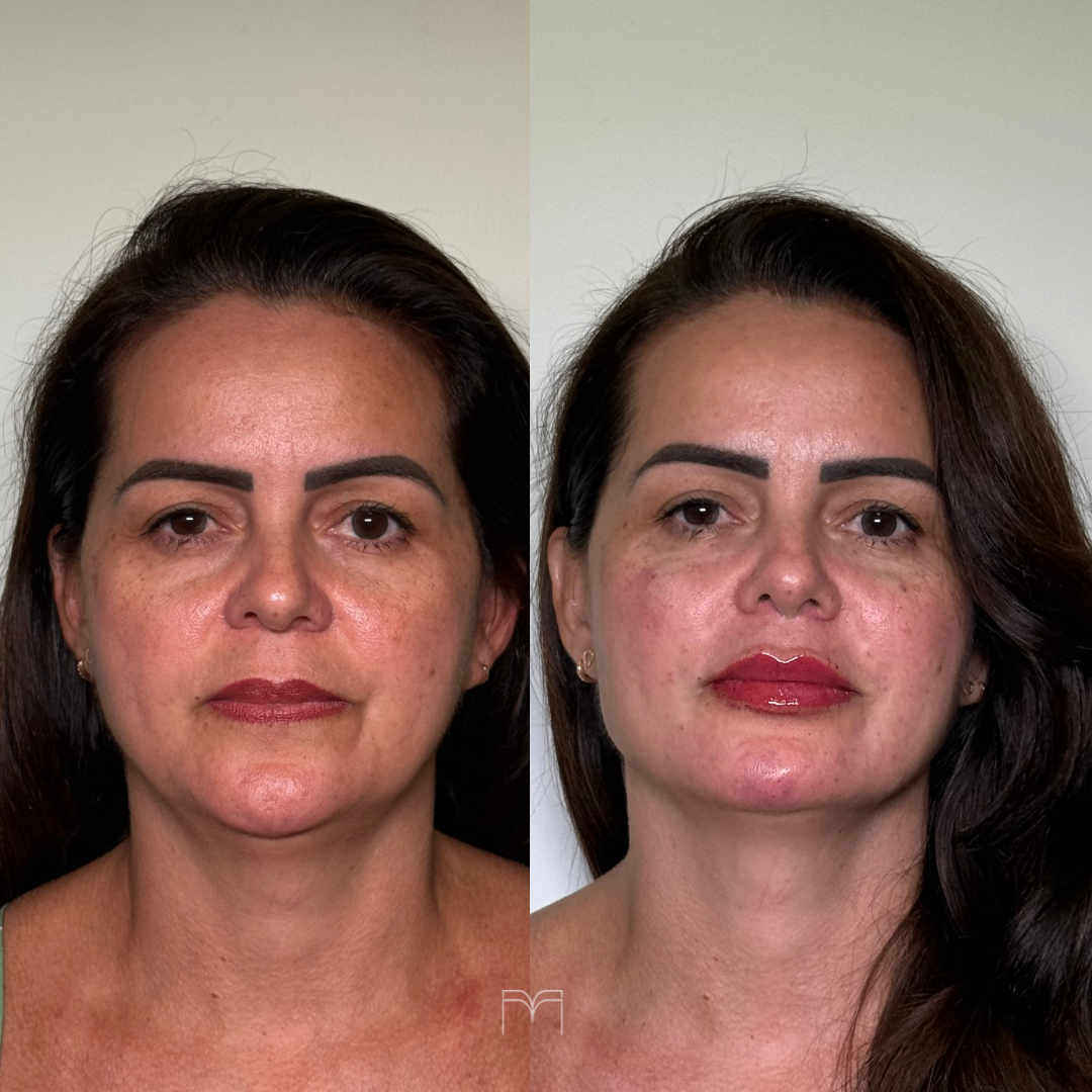 Resultado real 8 — Clínica Maryanna Menezes